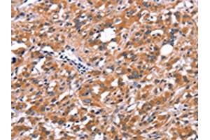 The image on the left is immunohistochemistry of paraffin-embedded Human thyroid cancer tissue using ABIN7190640(FDCSP Antibody) at dilution 1/25, on the right is treated with synthetic peptide. (FDCSP anticorps)
