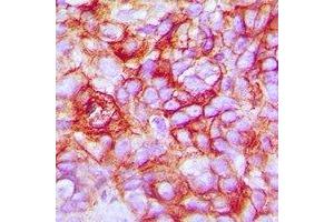 Immunohistochemical analysis of Taurine Transporter staining in human breast cancer formalin fixed paraffin embedded tissue section.