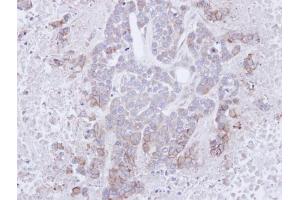 IHC-P Image Immunohistochemical analysis of paraffin-embedded MDAMB468 xenograft, using CD272, antibody at 1:100 dilution.