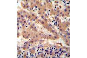 Immunohistochemistry analysis in formalin fixed and paraffin embedded human hepatocarcinoma reacted with Haptoglobin Antibody (Center) followed by peroxidase conjugation of the secondary antibody and DAB staining.