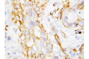 Immunohistochemical staining of paraffin-embedded human lung cancer tissue section with DEFB1 polyclonal antibody . (beta Defensin 1 anticorps  (C-Term))