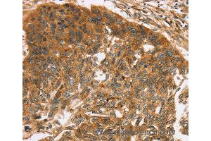 Immunohistochemistry of Human esophagus cancer using TNFSF15 Polyclonal Antibody at dilution of 1:40 (TNFSF15 anticorps)