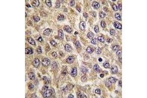 IHC analysis of FFPE human hepatocarcinoma tissue stained with ILK antibody (ILK anticorps  (AA 225-253))
