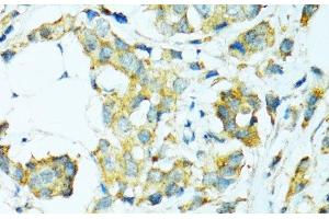 Immunohistochemistry of paraffin-embedded Human breast cancer using CYP2B6 Polyclonal Antibody at dilution of 1:100 (40x lens).