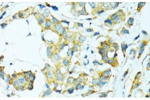 Immunohistochemistry of paraffin-embedded Human breast cancer using CYP2B6 Polyclonal Antibody at dilution of 1:100 (40x lens). (CYP2B6 anticorps)