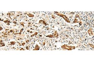 Immunohistochemistry of paraffin-embedded Human prost at e cancer tissue using GPR160 Polyclonal Antibody at dilution of 1:35(x200) (GPR160 anticorps)