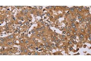 Immunohistochemistry of paraffin-embedded Human liver cancer using DDAH1 Polyclonal Antibody at dilution of 1:50 (DDAH1 anticorps)
