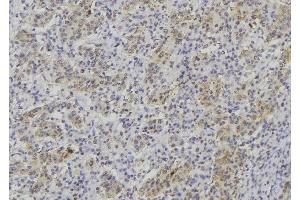 ABIN6277021 at 1/100 staining Human lung cancer tissue by IHC-P. (TPSAB1 anticorps  (C-Term))