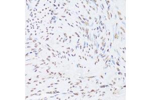 Immunohistochemistry of paraffin-embedded human adenomyosis using HNRNPD Antibody.