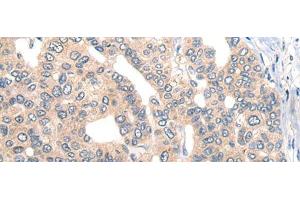 Immunohistochemistry of paraffin-embedded Human liver cancer tissue using CORO2B Polyclonal Antibody at dilution of 1:50(x200) (CORO2B anticorps)