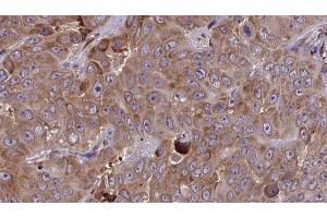 ABIN6273853 at 1/100 staining Human liver cancer tissue by IHC-P. (G Protein-Coupled Receptor 133 anticorps  (Internal Region))