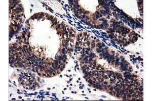 Immunohistochemical staining of paraffin-embedded Human liver tissue using anti-ADSL mouse monoclonal antibody.