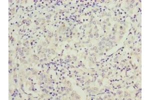 Immunohistochemistry of paraffin-embedded human lung cancer using ABIN7166922 at dilution of 1:100 (C9orf64 anticorps  (AA 182-341))