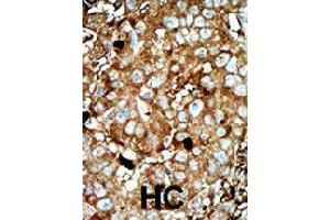 Formalin-fixed and paraffin-embedded human hepatocellular carcinoma tissue reacted with PFKFB3 polyclonal antibody  , which was peroxidase-conjugated to the secondary antibody, followed by AEC staining. (PFKFB3 anticorps  (C-Term))