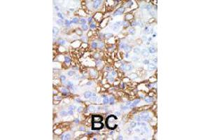 Formalin-fixed and paraffin-embedded human cancer tissue reacted with MAP4K1 polyclonal antibody  , which was peroxidase-conjugated to the secondary antibody, followed by DAB staining. (MAP4K1 anticorps  (C-Term))