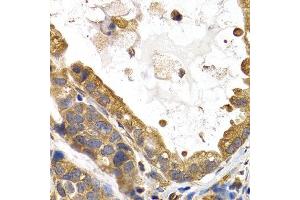 Immunohistochemistry of paraffin-embedded human stomach cancer using GYS1 antibody at dilution of 1:200 (400x lens). (Glycogen Synthase 1 anticorps)