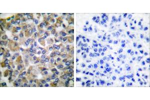 Peptide - +Immunohistochemical analysis of paraffin-embedded human breast carcinoma tissue using GRP75 antibody (#C0216). (HSPA9 anticorps)