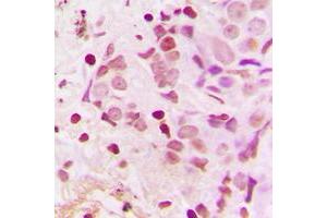 Immunohistochemical analysis of TSHZ1 staining in human breast cancer formalin fixed paraffin embedded tissue section.