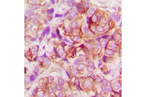 Immunohistochemical analysis of BAX staining in human lung cancer formalin fixed paraffin embedded tissue section. (BAX anticorps  (N-Term))
