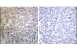 Immunohistochemistry analysis of paraffin-embedded human breast carcinoma tissue, using FGFR1 (Ab-766) Antibody. (FGFR1 anticorps  (AA 736-785))