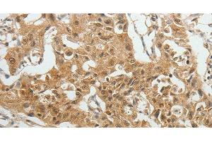 Immunohistochemistry of paraffin-embedded Human lung cancer tissue using SYT6 Polyclonal Antibody at dilution 1:40 (SYT6 anticorps)