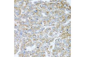 Immunohistochemistry of paraffin-embedded human liver cancer using NDUFA2 antibody.