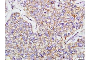 Paraformaldehyde-fixed, paraffin embedded human lung carcinoma tissue, Antigen retrieval by boiling in sodium citrate buffer(pH6) for 15min, Block endogenous peroxidase by 3% hydrogen peroxide for 30 minutes, Blocking buffer (normal goat serum) at 37°C for 20min, Antibody incubation with Rabbit Anti-N-cadherin Polyclonal Antibody, Unconjugated  at 1:400 overnight at 4°C, followed by a conjugated secondary and DAB staining