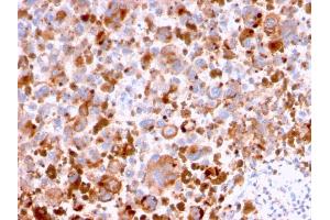 Formalin-fixed, paraffin-embedded human Melanoma stained with CD63 Mouse Monoclonal Antibody (LAMP3/2788).