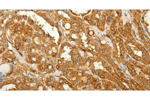 Immunohistochemistry of paraffin-embedded Human thyroid cancer tissue using RAB35 Polyclonal Antibody at dilution 1:50 (RAB35 anticorps)