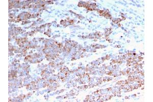 Formalin-fixed, paraffin-embedded human Colon Carcinoma stained with Cytokeratin 18 Mouse Monoclonal Antibody (rKRT18/1190).