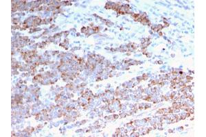 Formalin-fixed, paraffin-embedded human Colon Carcinoma stained with Cytokeratin 18 Mouse Monoclonal Antibody (rKRT18/1190). (Recombinant Cytokeratin 18 anticorps)