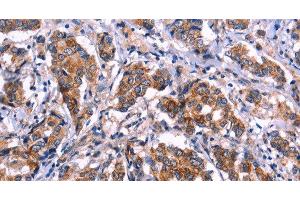 Immunohistochemistry of paraffin-embedded Human breast cancer tissue using EIF2AK4 Polyclonal Antibody at dilution 1:50 (GCN2 anticorps)