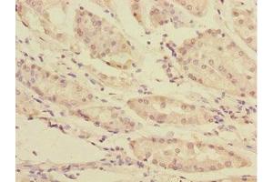 Immunohistochemistry of paraffin-embedded human gastric cancer using ABIN7166196 at dilution of 1:100 (TOB2 anticorps  (AA 1-70))