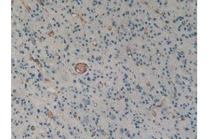 DAB staining on IHC-P; Samples: Human Glioma Tissue