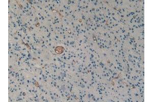 DAB staining on IHC-P; Samples: Human Glioma Tissue (Urotensin 2 anticorps  (AA 20-120))