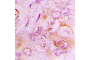 Immunohistochemical analysis of Serpin B9 staining in human lung cancer formalin fixed paraffin embedded tissue section.