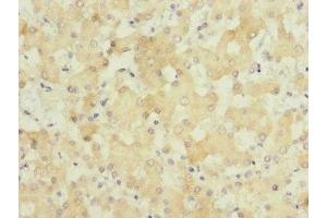 Immunohistochemistry of paraffin-embedded human liver cancer using ABIN7154045 at dilution of 1:100 (GATC anticorps  (AA 1-136))