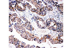 Anti-Caspase-3(P10),  IHC(P) IHC(P): Human Intestinal Cancer Tissue