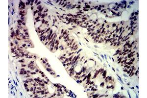 Immunohistochemical analysis of paraffin-embedded rectum cancer tissues using BTRC mouse mAb with DAB staining.