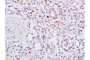 Formalin-fixed and paraffin embedded human gastric carcinoma labeled with Anti-Phospho-HSP90 alpha (Thr5 + Thr7) Polyclonal Antibody, Unconjugated (ABIN685333) at 1:200 followed by conjugation to the secondary antibody and DAB staining