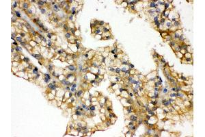 Anti- Aquaporin 2 Picoband antibody, IHC(P) IHC(P): Human Kidney Cancer Tissue (AQP2 anticorps  (C-Term))