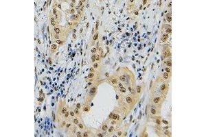 Immunohistochemical analysis of Topoisomerase 2 alpha staining in human lung cancer formalin fixed paraffin embedded tissue section.