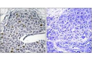 Immunohistochemistry analysis of paraffin-embedded human lung carcinoma tissue, using IRF3 (Ab-385) Antibody.
