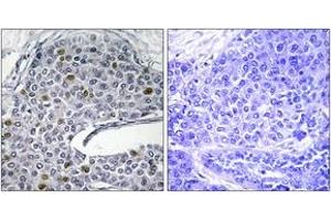 Immunohistochemistry analysis of paraffin-embedded human lung carcinoma tissue, using IRF3 (Ab-385) Antibody. (IRF3 anticorps  (AA 351-400))