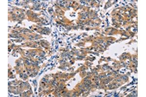 The image on the left is immunohistochemistry of paraffin-embedded Human gastic cancer tissue using ABIN7128293(AGPAT4 Antibody) at dilution 1/25, on the right is treated with fusion protein.