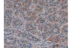 IHC-P analysis of Human Liver Cancer Tissue, with DAB staining. (COL4A1 anticorps  (AA 1444-1669))