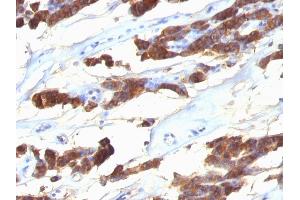Formalin-fixed, paraffin-embedded human Thyroid Carcinoma stained with Thyroglobulin Monoclonal Antibody (SPM221).