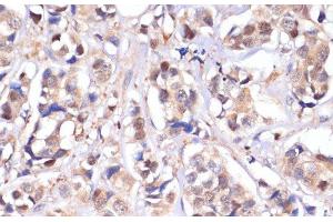 Immunohistochemistry of paraffin-embedded Human breast cancer using STK4 Polyclonal Antibody at dilution of 1:100 (40x lens).