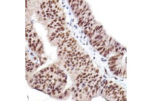 Immunohistochemistry of paraffin-embedded human colon carcinoma using Phospho--S473+-S474+-S472 Rabbit pAb (ABIN7265523) at dilution of 1:100 (40x lens). (AKT 1/2/3 anticorps  (pSer472))