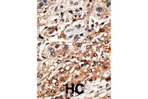 Formalin-fixed and paraffin-embedded human hepatocellular carcinoma tissue reacted with the BMF polyclonal antibody  , which was peroxidase-conjugated to the secondary antibody, followed by DAB staining. (BMF anticorps  (AA 130-150))